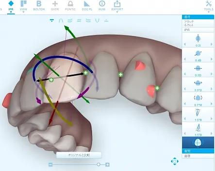 3Dスキャナーで取得した歯の3Dデータ