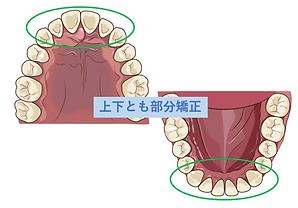 上歯と下歯のイラスト　上下とも部分矯正